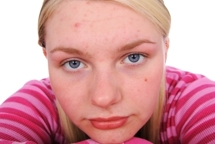 Photo of client before an Acne Control Facial treatment.